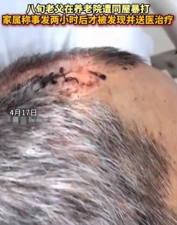 内蒙古赤峰，女子将丈夫送到养老院，几天后接丈夫，只见丈夫裤子直接裂开到裤裆，上衣