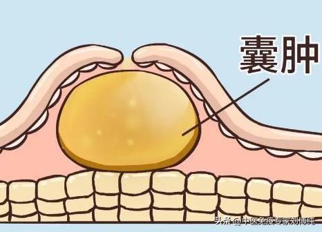 囊肿反复长？按照这3步，帮你解决问题！
大家好，我是中医刘博纯！
现在啊，患有囊