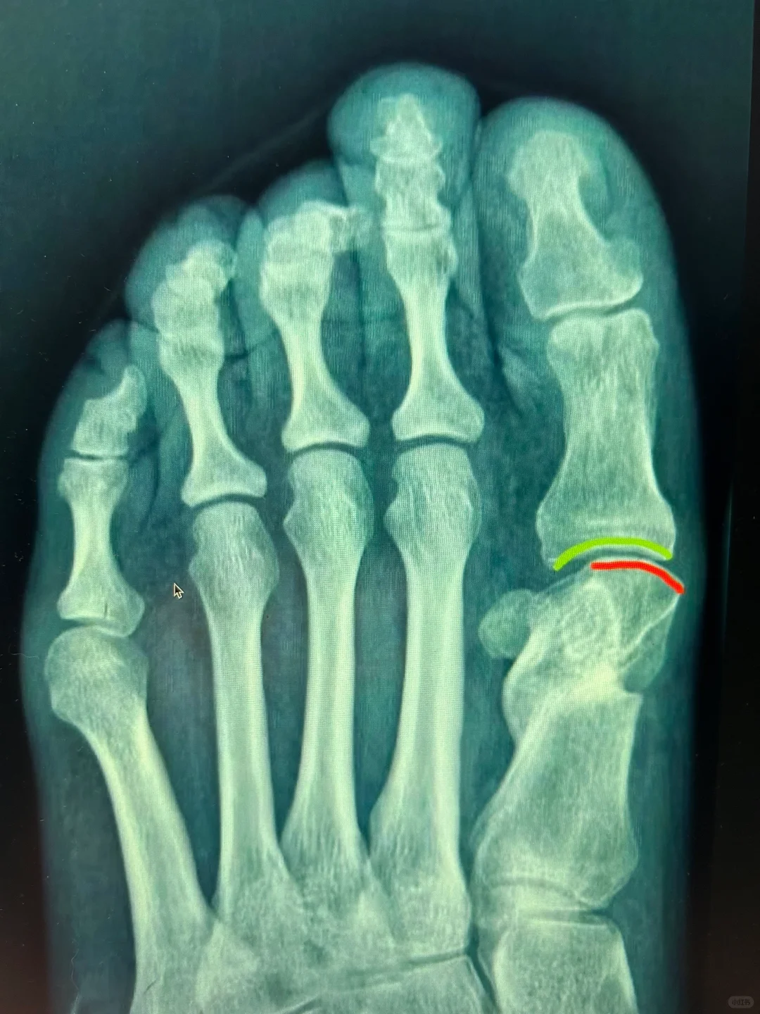 片子直就没问题了吗？