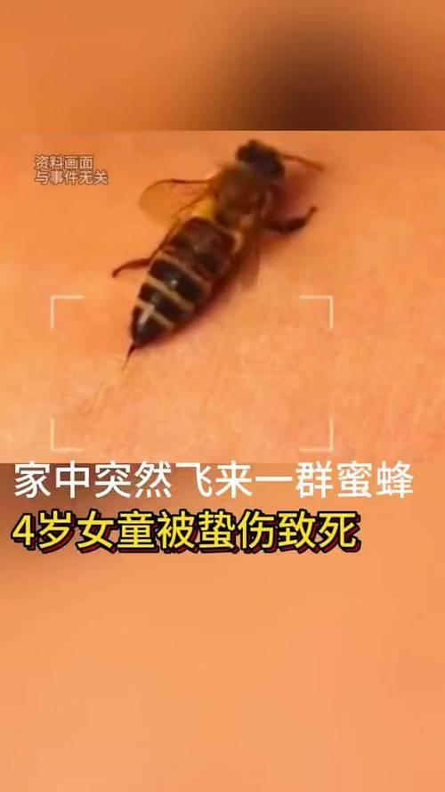 近日，一医生向记者讲述他曾接诊的病例：一小女孩被蜜蜂蛰伤，事发后，母亲未选择3分