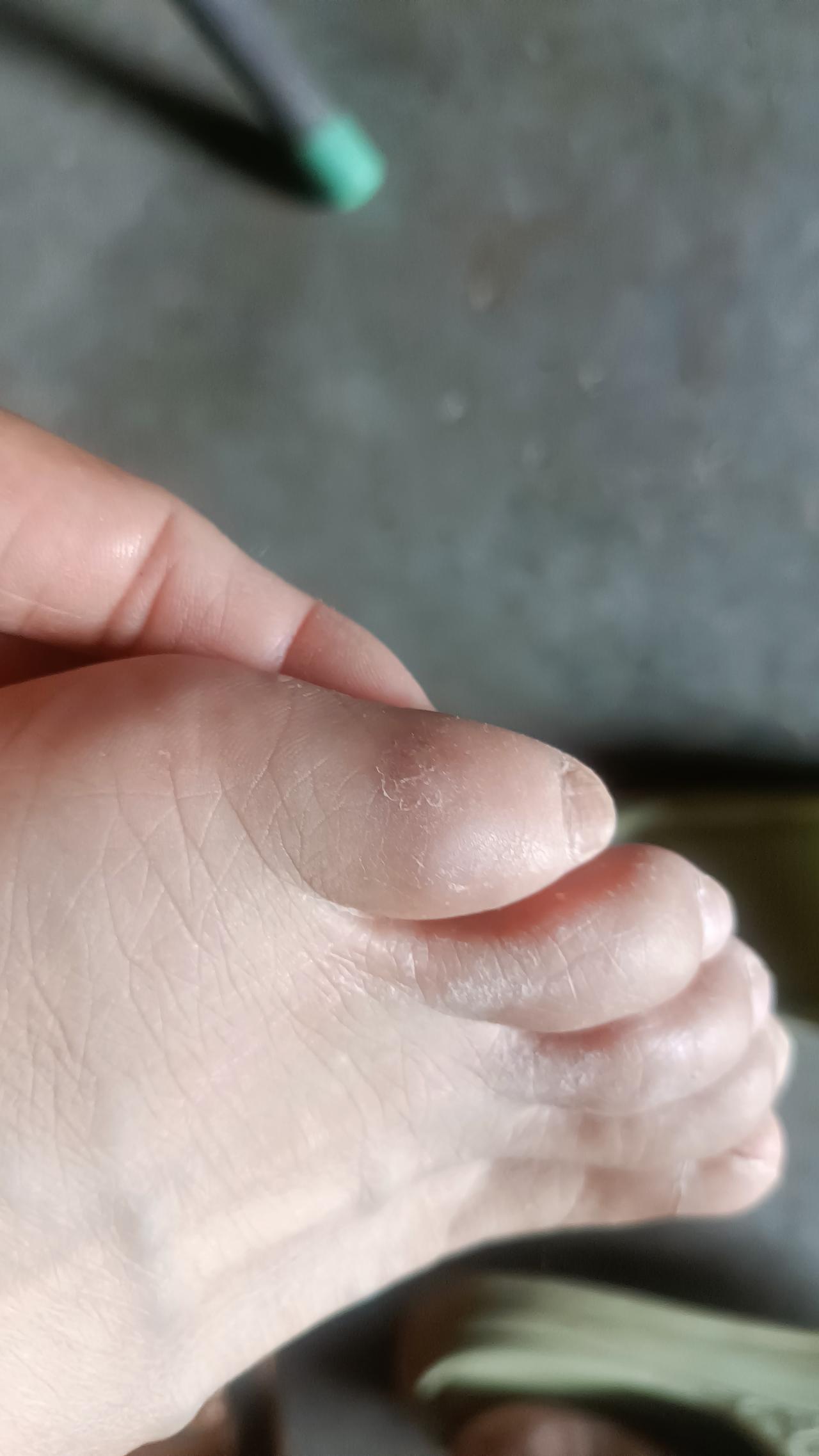看看我这类风湿的脚和手。
全是肿胀和变形的，得了这种病，人是没有尊严的。
类风湿