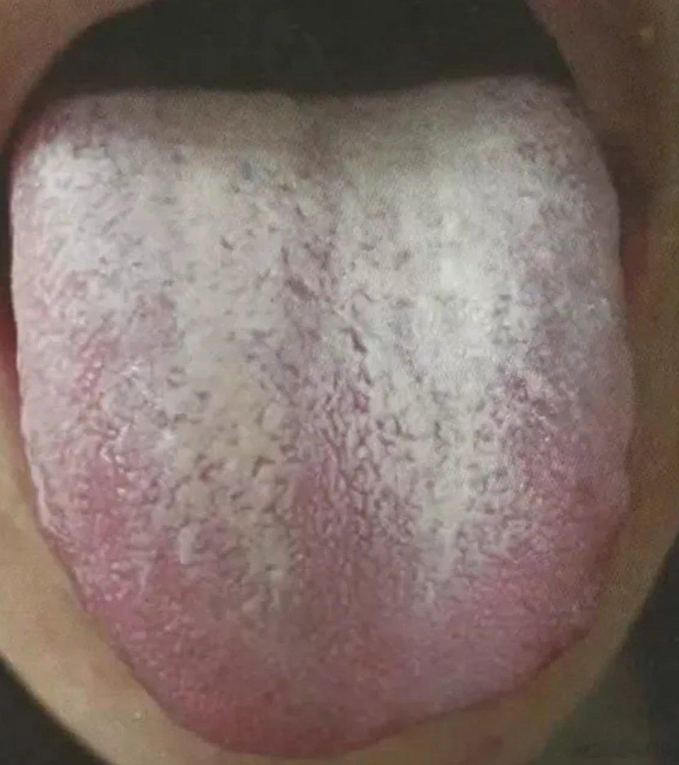 给大家分享一例粉丝的舌象，看看大家有哪些类似情况。第一，舌头白腻。多是脾胃湿浊，
