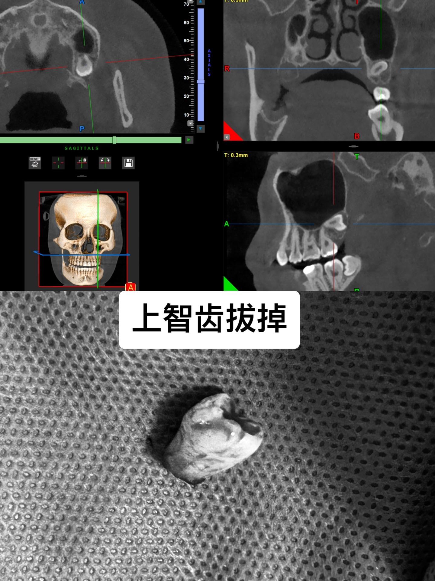 第一次来，我拒绝了，没必要拔。 第二次又来要求拔除。好吧