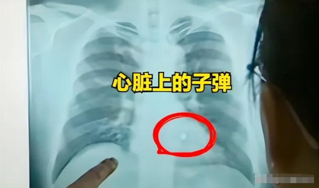 1995年湖南，符桂林遭遇枪击，子弹竟在他体内神秘消失。医生们困惑不已，无奈只得