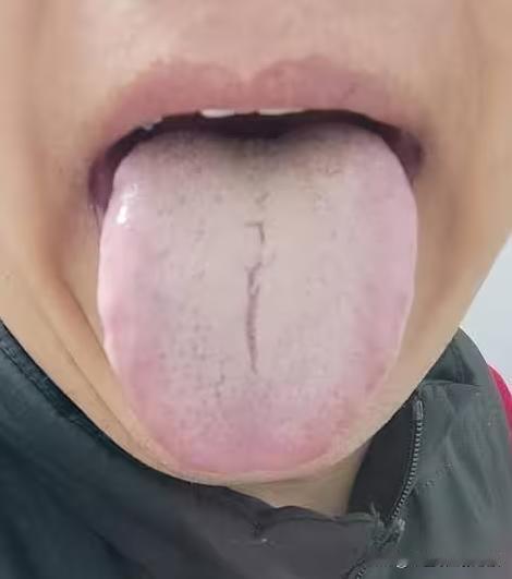 门诊上碰到一个经典舌，男36岁，舌面毫无血色[不看][不看][不看]
二陈丸，参