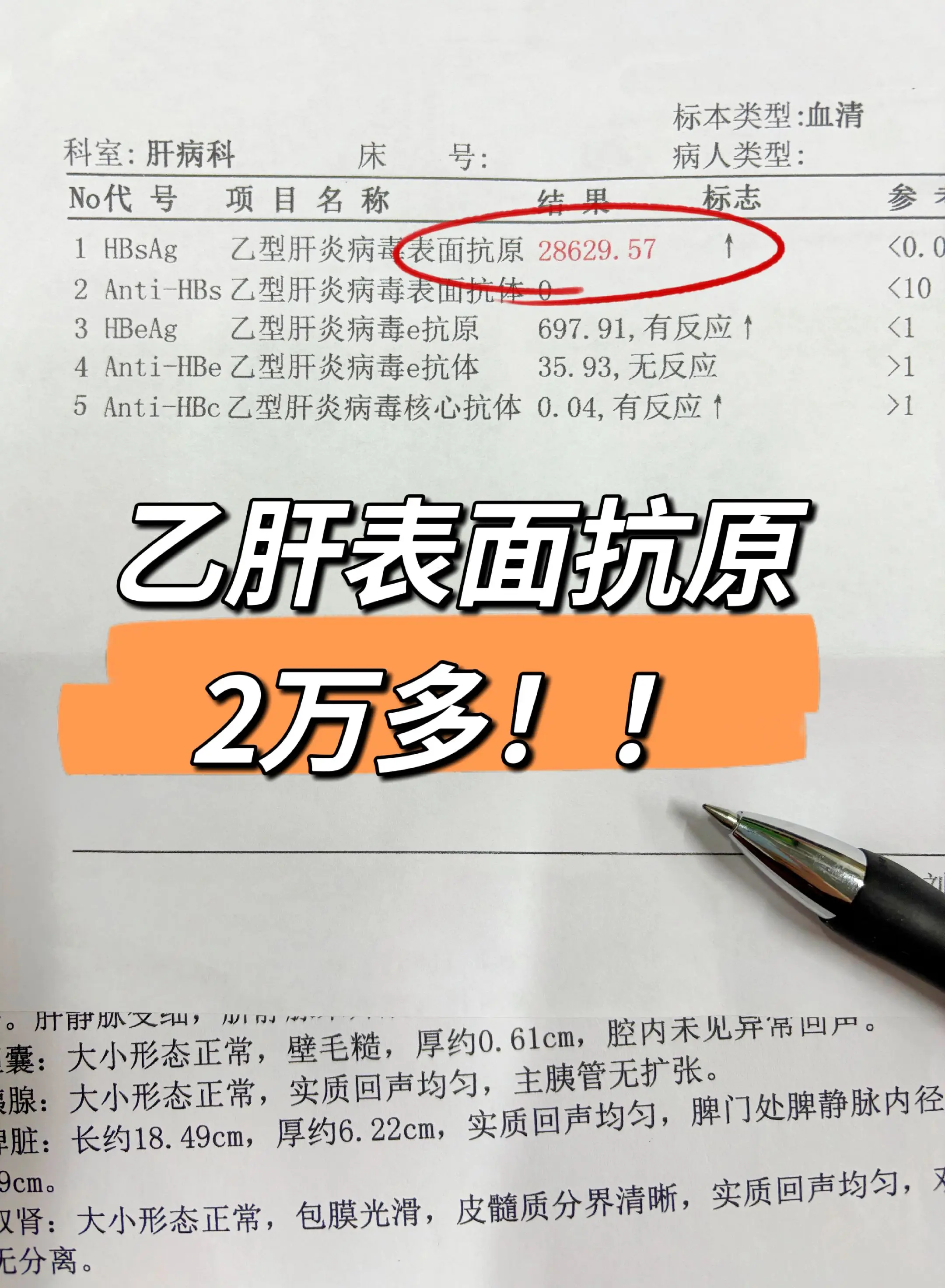 乙肝表面抗原2万多！！！乙肝表面抗原2万多，肝功能也出现异常，转氨酶1...