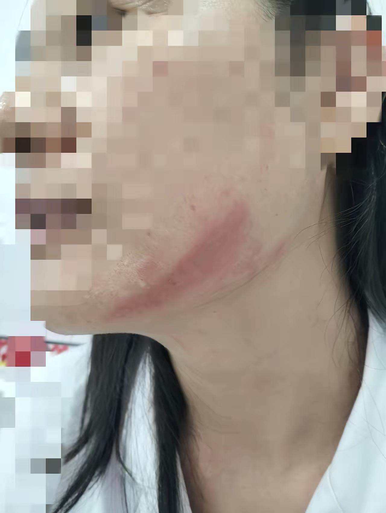 女子脸上被虫子泼了硫酸
大家晚上如果感觉到脸上有什么异常的时候，第一时间千万不要