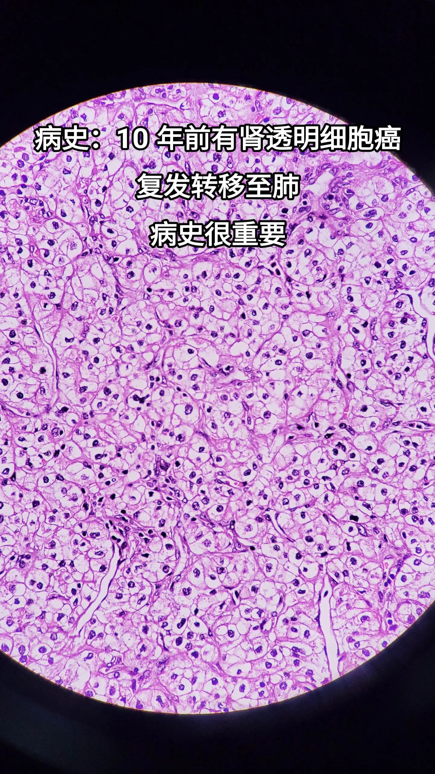 肾透明细胞癌  肾癌晚期  复发转移
