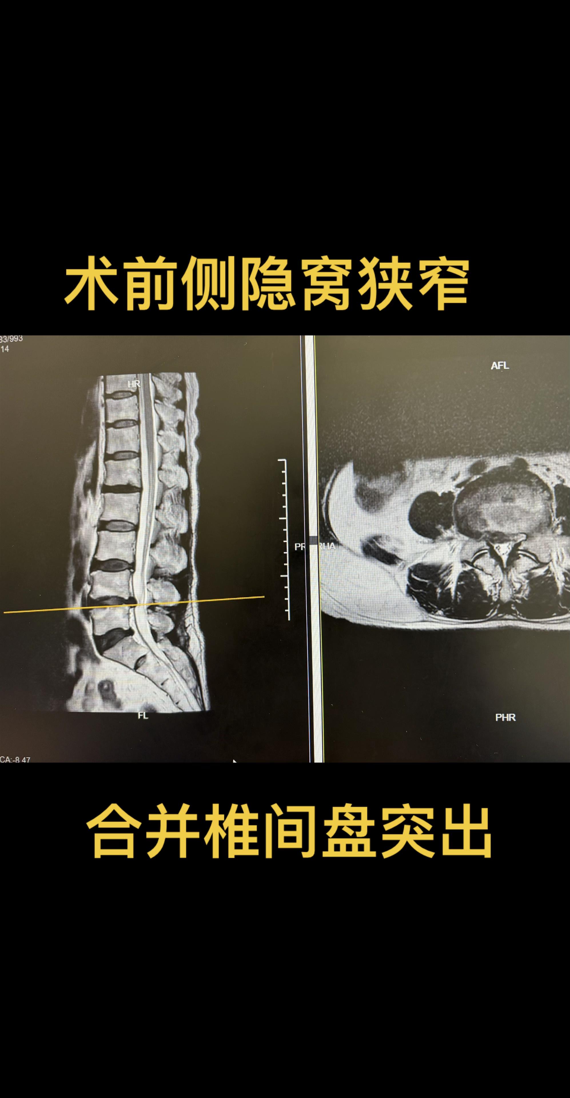 适度就是最好的。该患者手术前右下肢酸胀疼痛难忍，保守治疗中口服止痛药物...