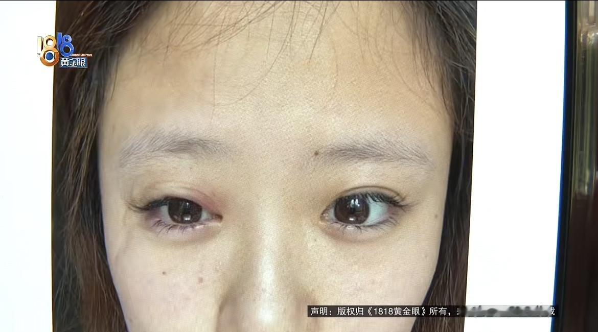 浙江宁波，一女子为赴南京旅游专程去种睫毛，本想美美拍照，结果旅游当晚眼睛就红肿不