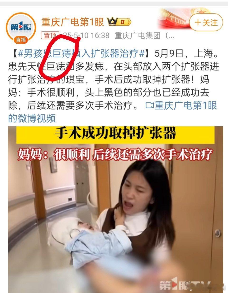 想问问  ，到底是“巨痔”还是“巨痣”。谁家痔疮长脑袋上吗？还是说“巨痔”比较有