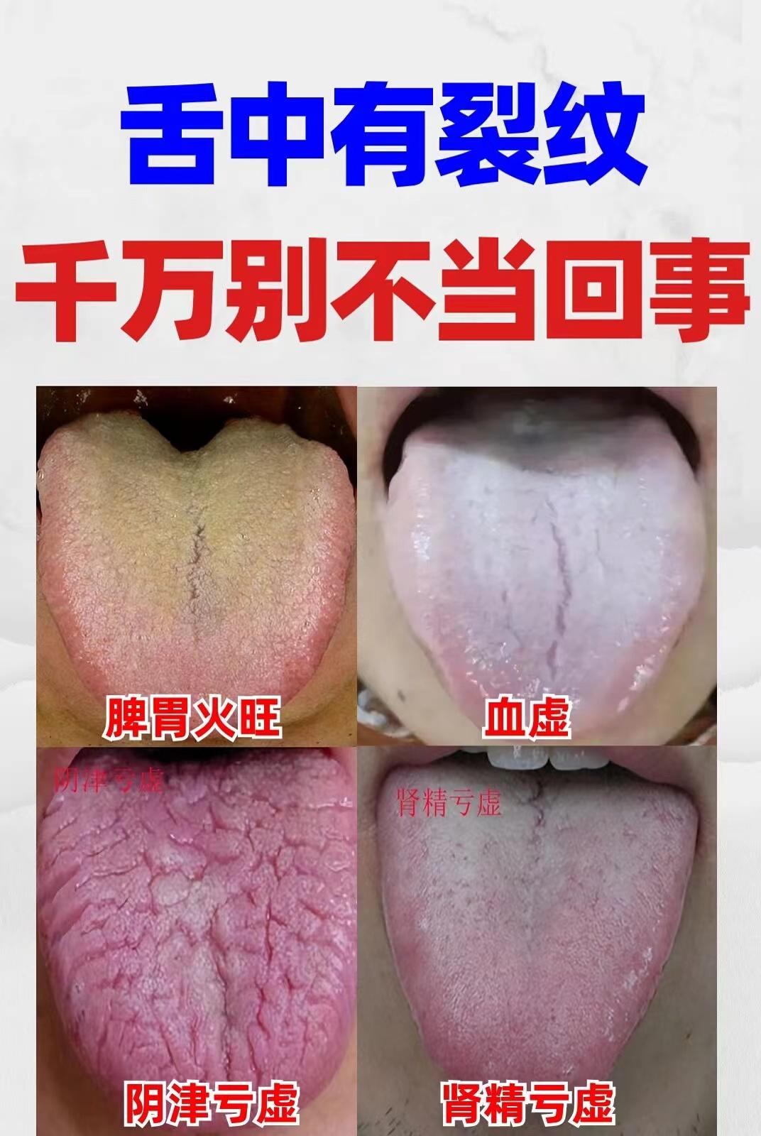 舌头上有裂纹，或是多种疾病征兆！发现这4种舌象，别再不当回事了[中国赞][中国赞