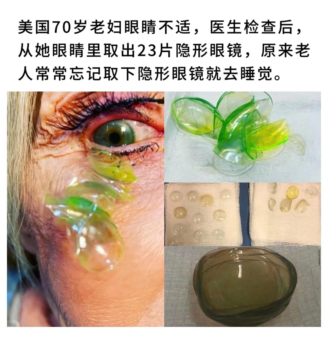 美国70岁老妇眼睛不适，医生检查后，从她眼睛里取出23片隐形眼镜
