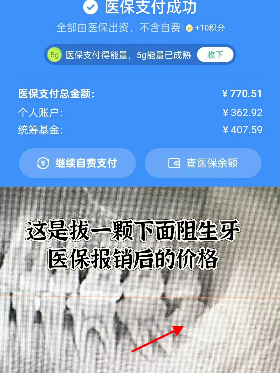 在南宁拔智齿为什么要浪费钱？