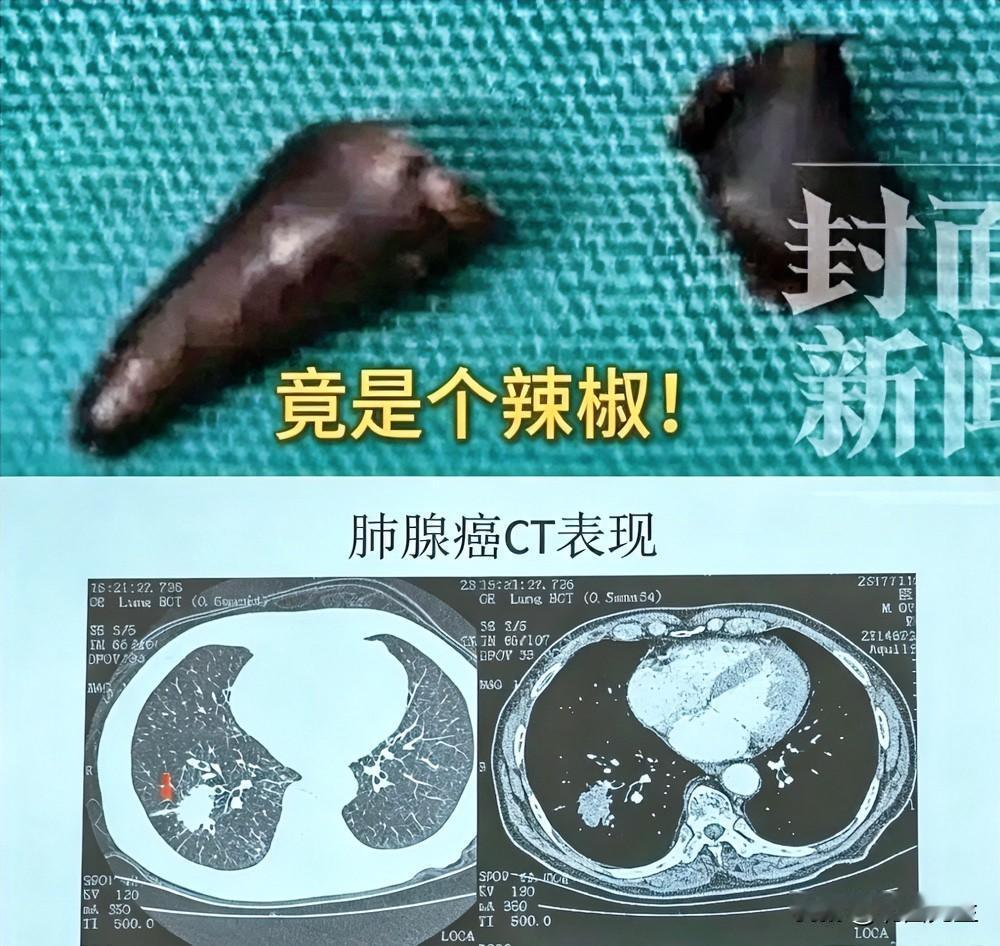 70岁大爷被“判肺癌”，开胸后掏出辣椒！

西安这大爷，70岁，一辈子嗜辣如命，