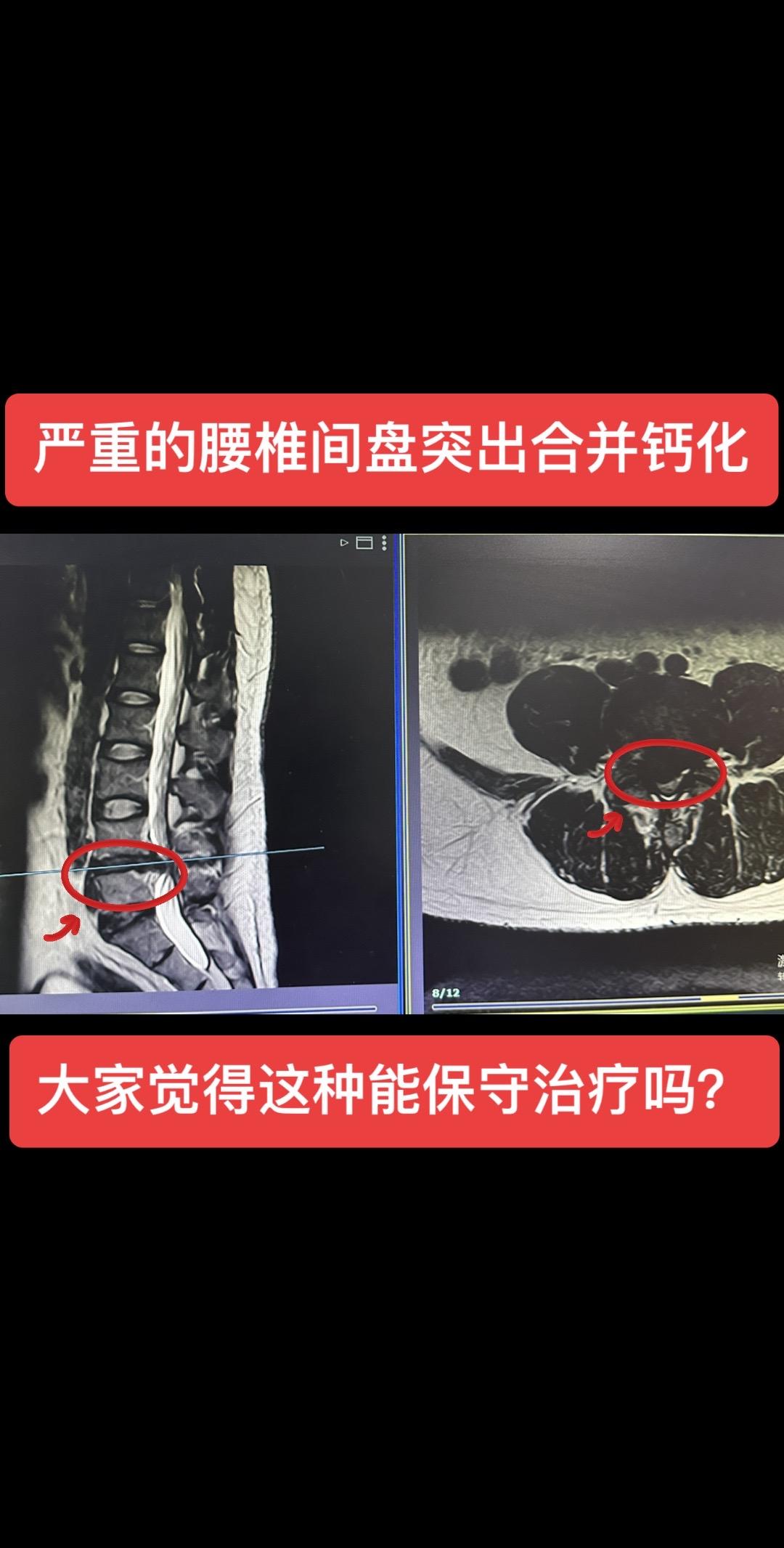 严重的腰椎间盘突出合并钙化，患者出现严重的下肢疼痛麻木，不能行走，大家觉得这种能保守治疗吗？