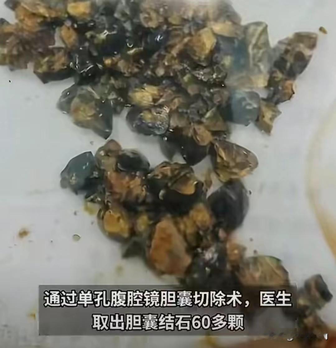 南京女子腹痛手术取出60多颗结石，
医生只说一句警示
 南京35岁王女士长期不吃