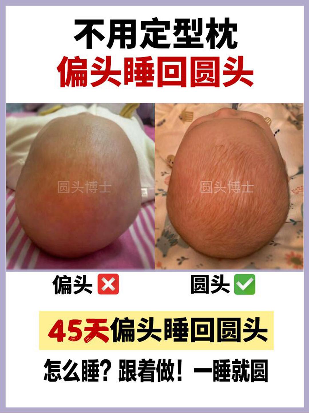 45天偏头宝宝睡回小圆头啦。