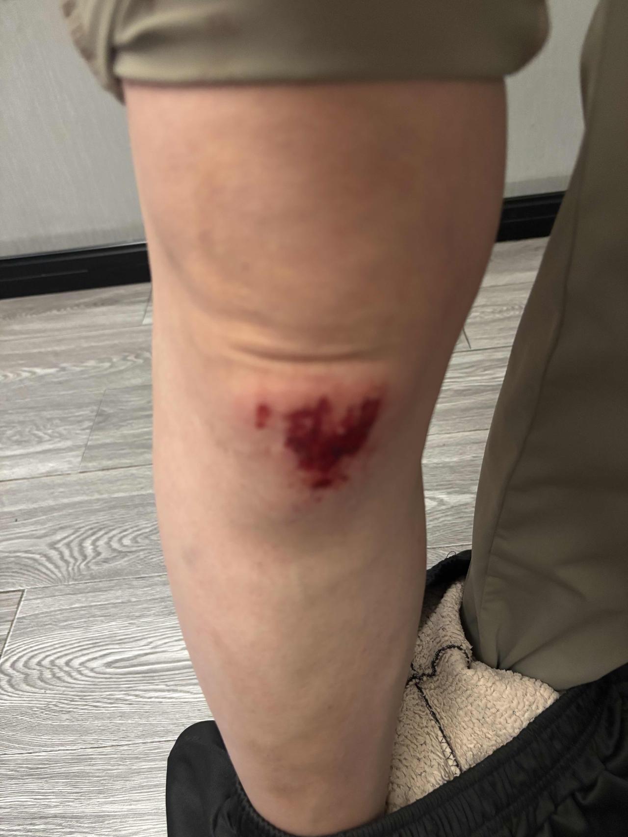 骑青桔共享单车刹车失灵摔伤，平台只赔医疗费？财产损失、人身伤害难道就白受了？
