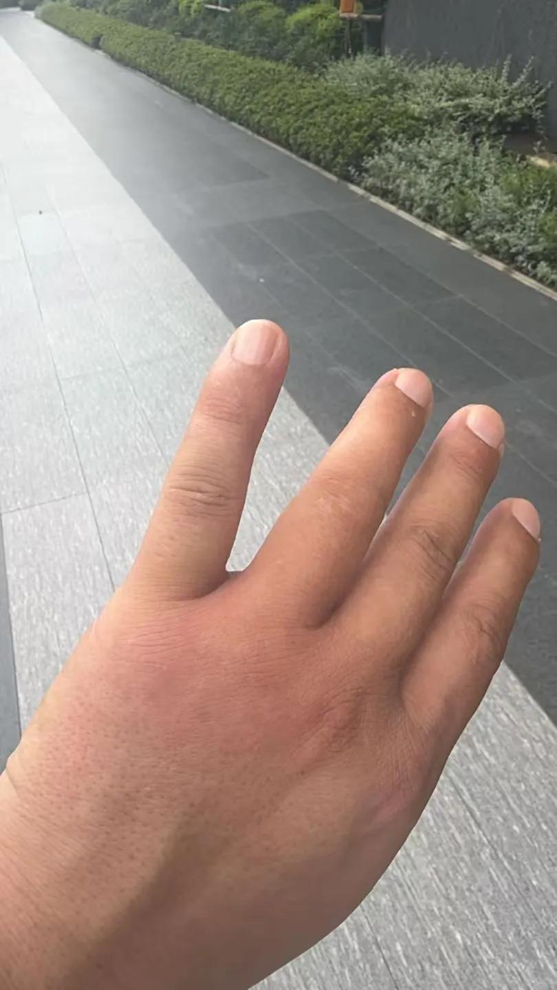 设计师今天去华曦府小区，看工地进度，刚下车往里走的时候手突然可疼，然后看到一个马