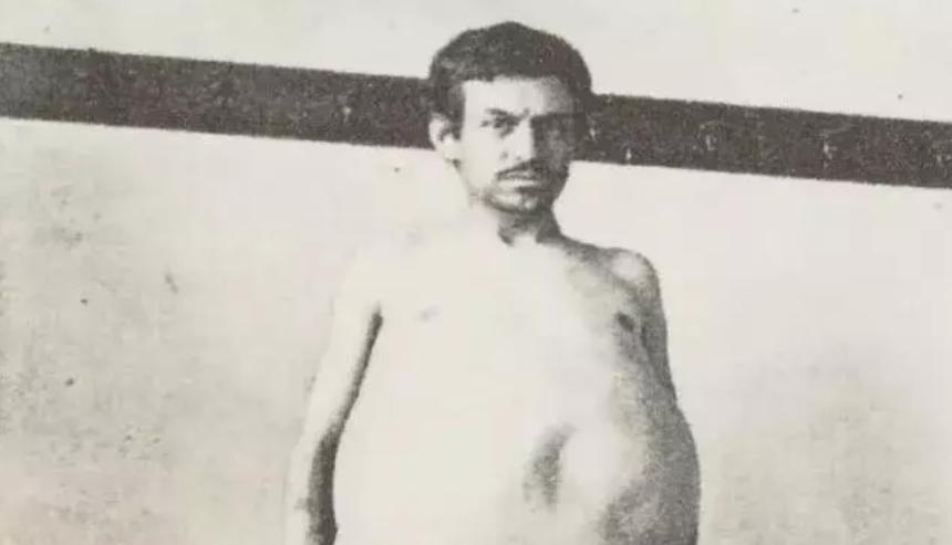 “他是被屎憋死的。”1940年，一美国男人因为三年没有排泄，最终不幸去世，医生检