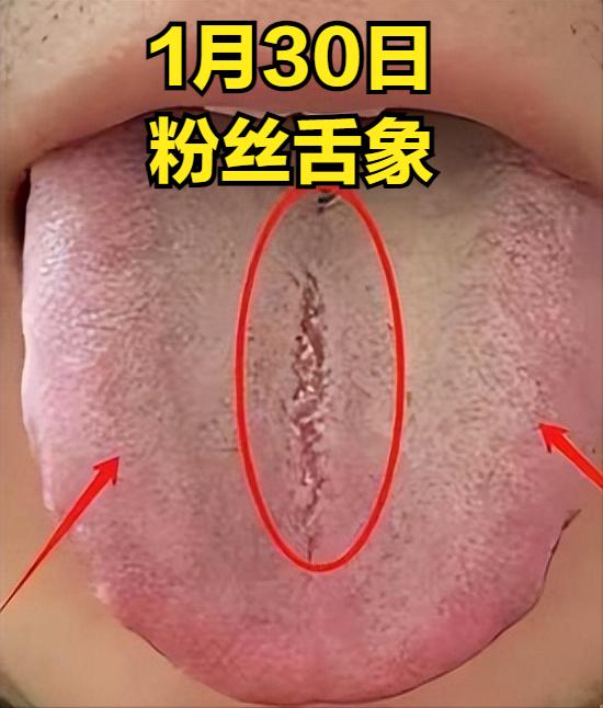 这种舌头，简直是五毒俱全，我只用两个小方子加减，一调就见效！
这会不忙，看舌直接