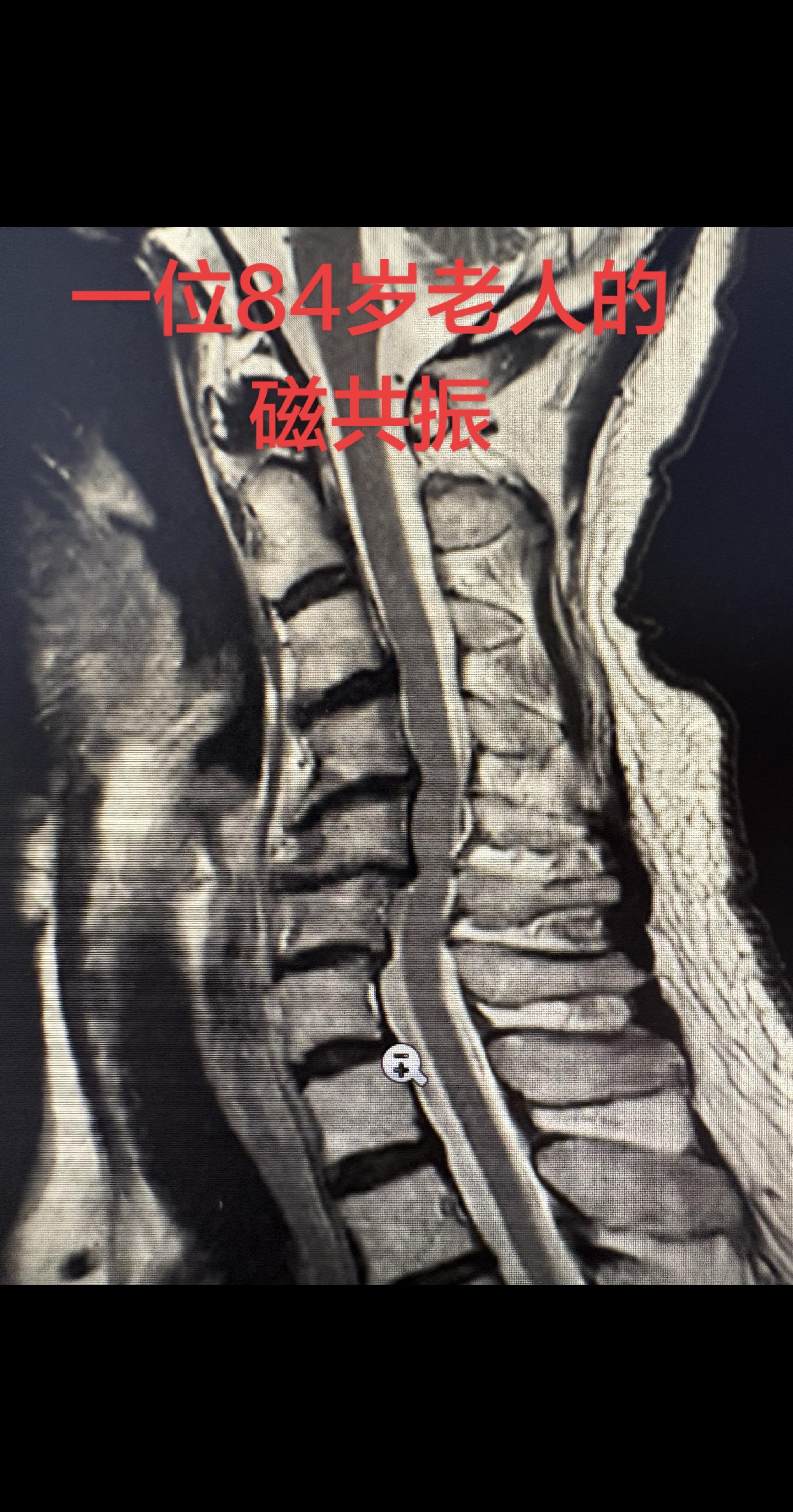 老年人的磁共振。这片子上的退变表现够典型了 突出、滑脱、骨赘、曲度反弓...