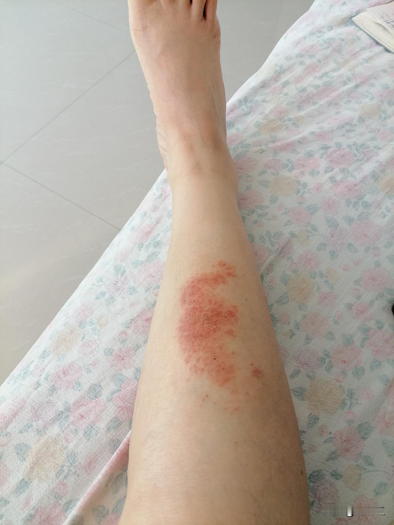 发现一件事，让我很惊讶。

昨晚，要睡前，我的腿痒的厉害，心都要抓挠出来。我忍不