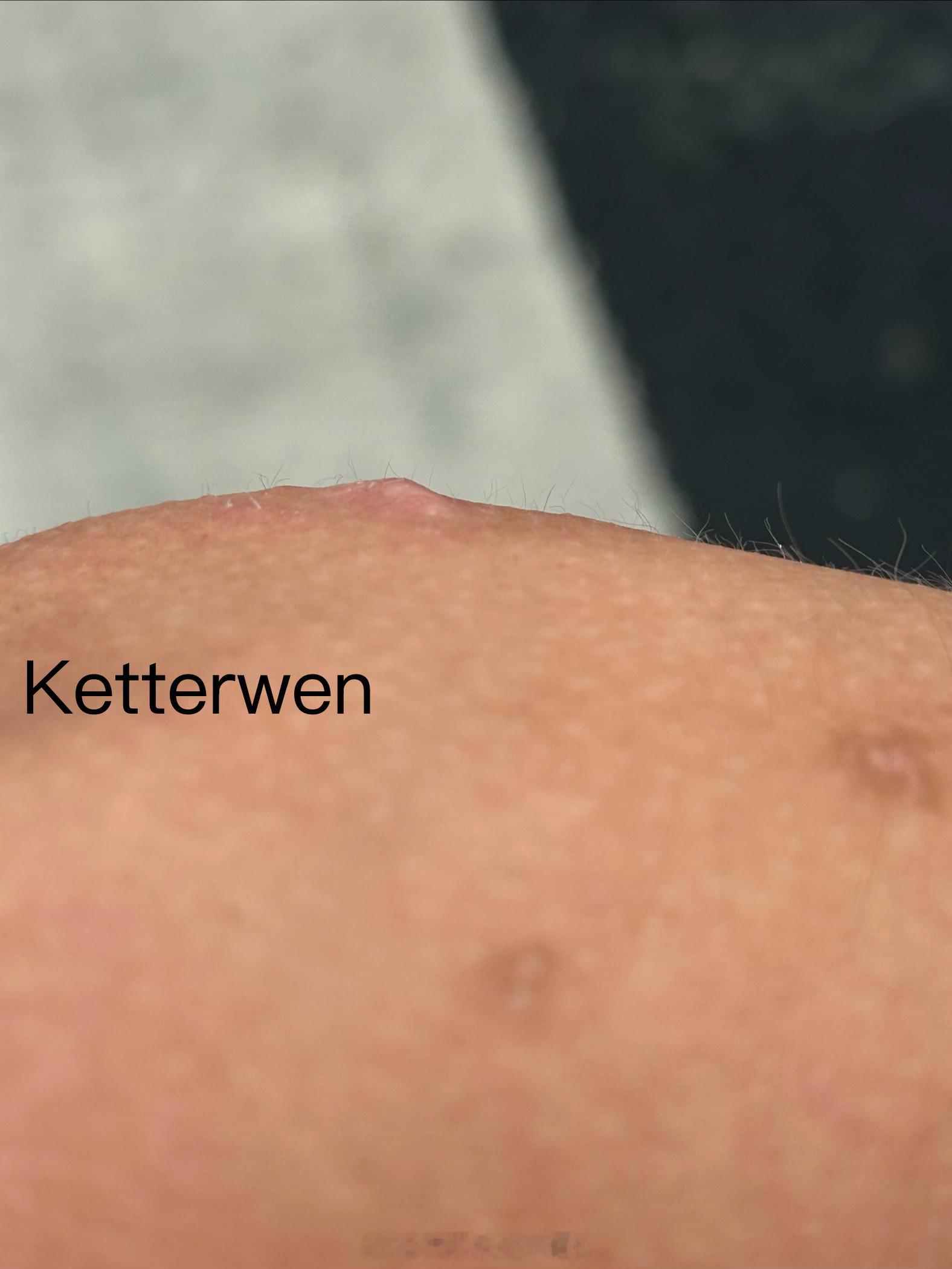 蚊子🦟竟然喜欢吃死皮  专栏 · ketterwenの騎行紀錄