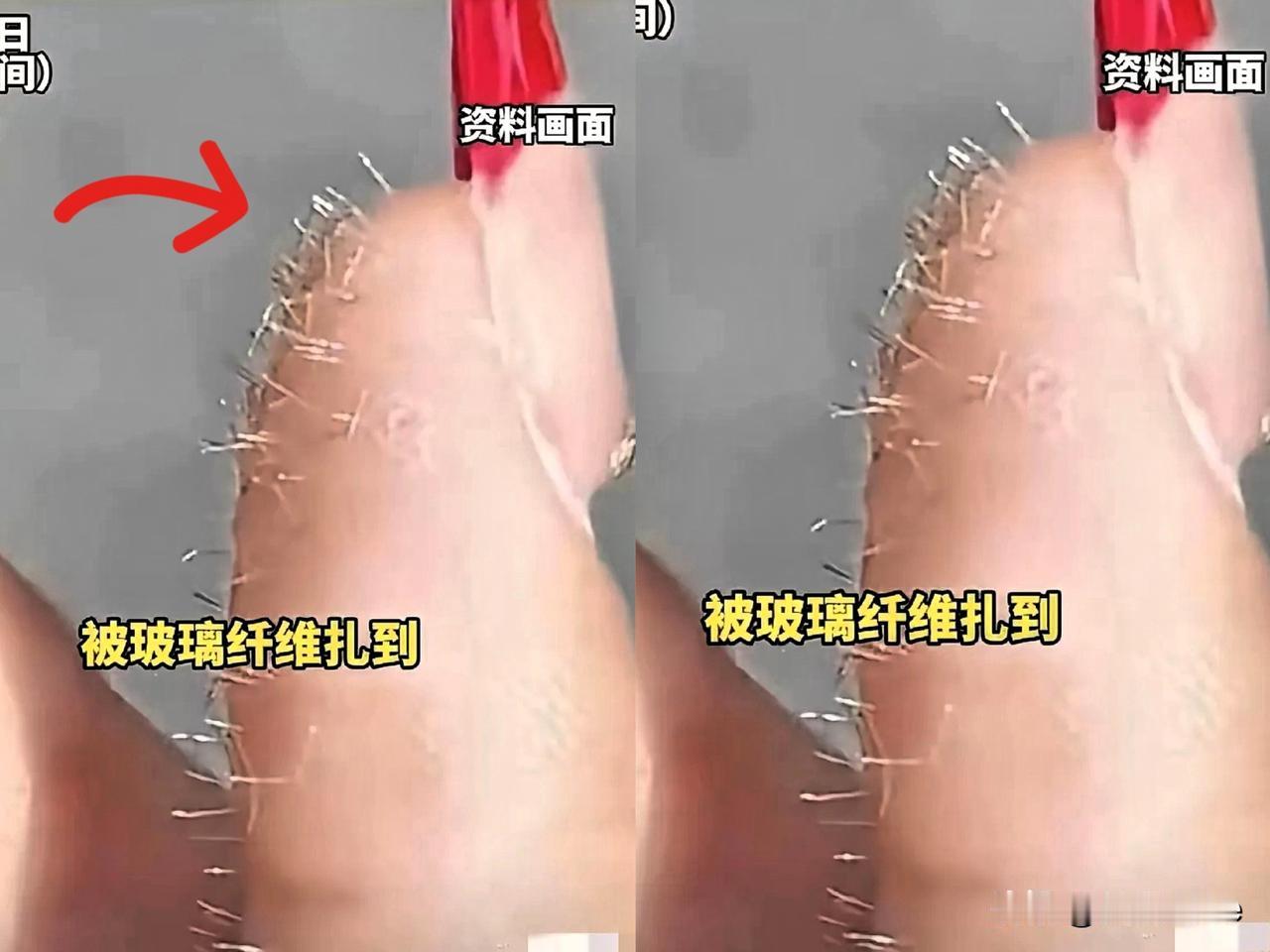 浙江这女生太绝了！手被玻璃纤维扎满，又刺又痒还看不见，她没去医院，也没盲目挑刺，