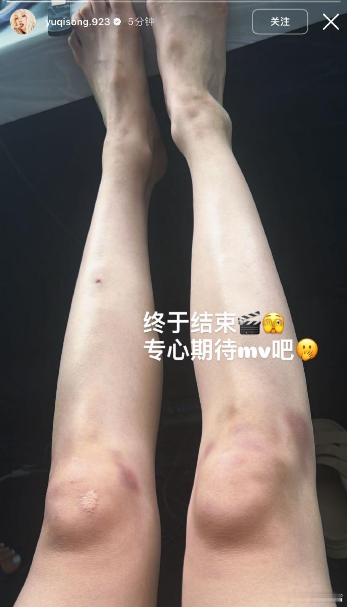 宋雨琦疑似回应恋情宋雨琦发布ins快拍，分享mv杀青之后的日常，膝盖满是拍摄留下
