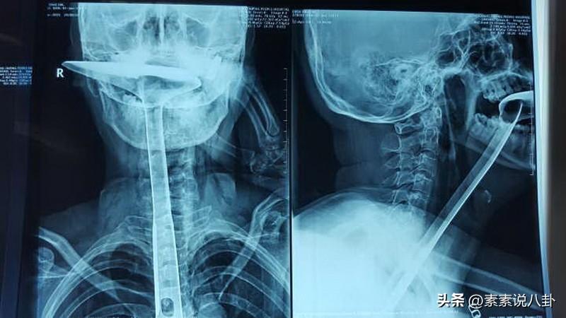 一上班，喉咙好疼，生存太难了