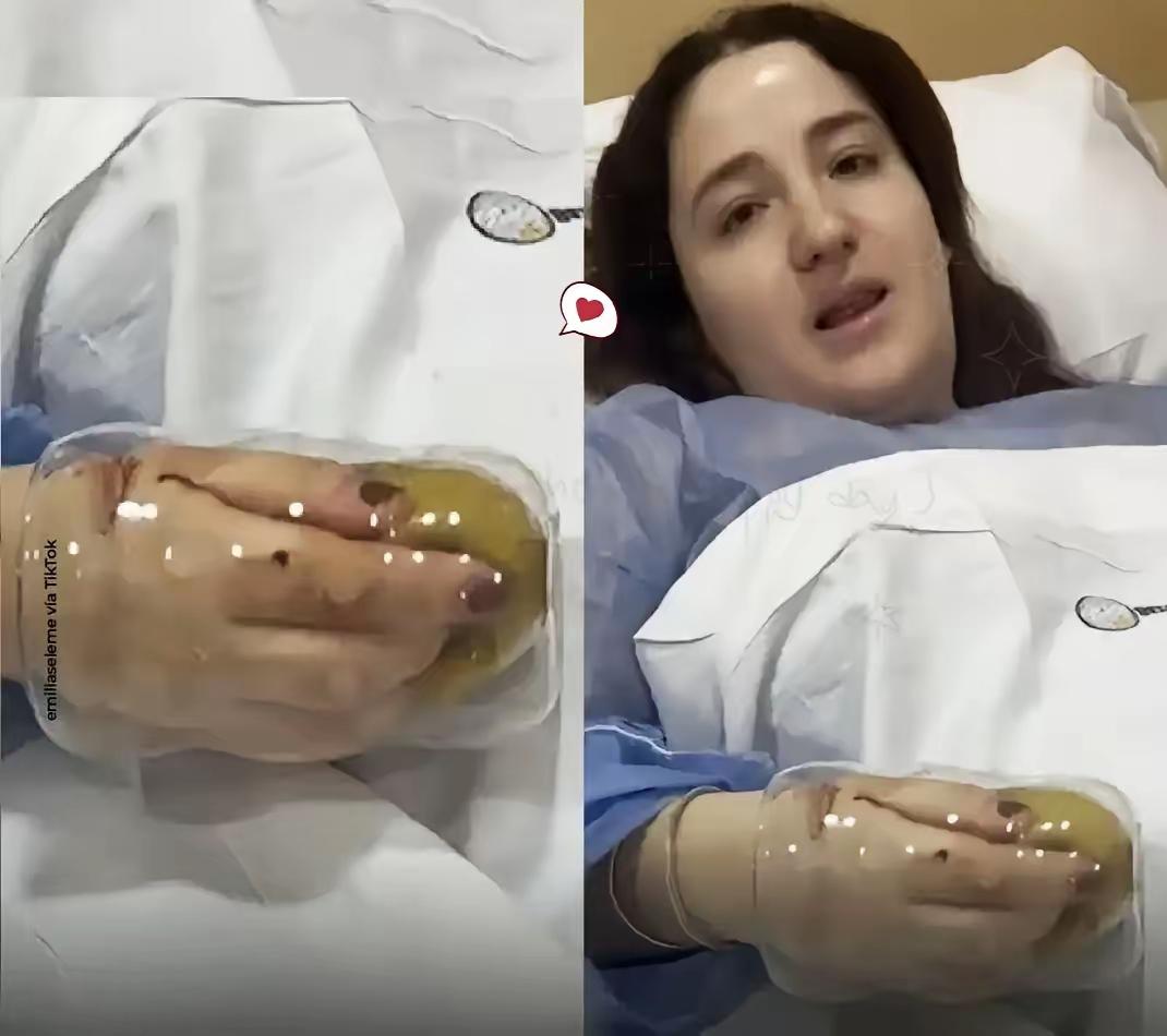 阿根廷大姐洗碗时手和抹布一起卡进玻璃杯，愣是在里面卡了近10小时才送医。玻璃杯太