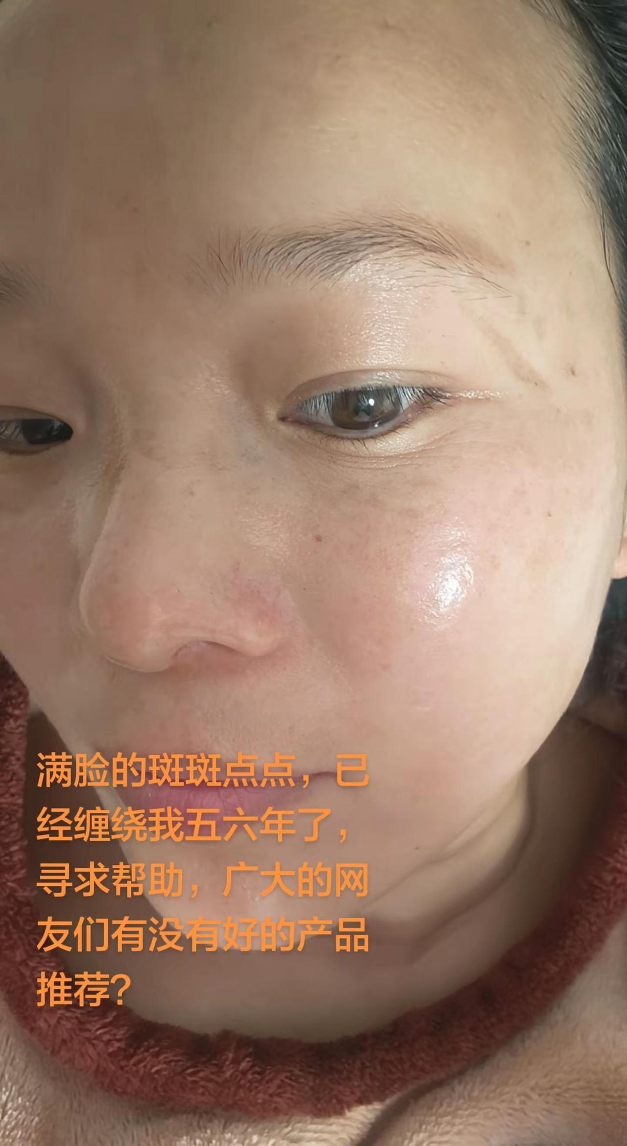 满脸的斑斑点点，已经缠了我五六年了。求广大网友们的帮助！原生相机里的自己 原相机