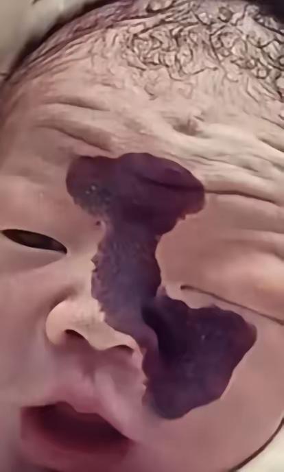 看哭了！一对年轻夫妻，怀孕时在检查室看到宝宝脸上有一道黑影，医生说可能是胎记，丈