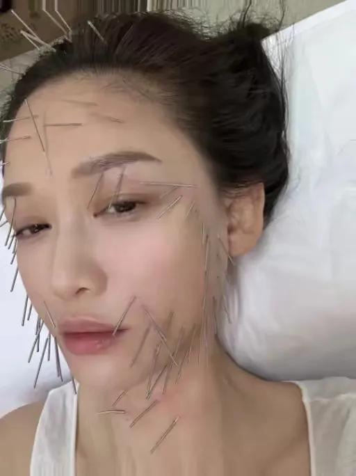 针灸真的太神奇！太厉害了！
陈乔恩的童颜原来都是靠针扎出来的
原来陈乔恩这么美都