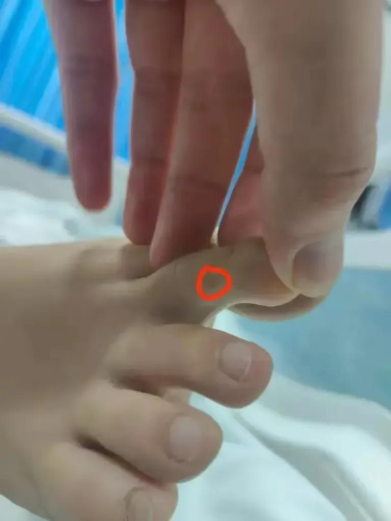 确实不能怪医生。

三亚女子被蛇咬伤身亡的伤口被曝光，伤口在第二根脚拇指上，在拍