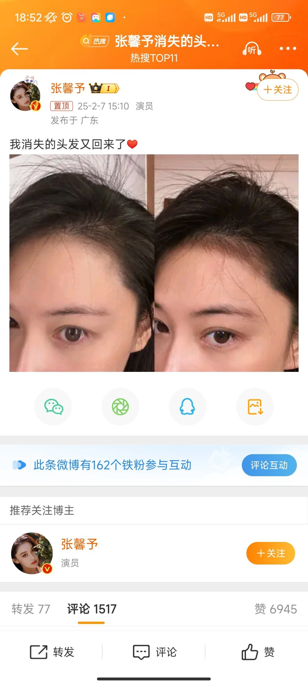 张馨予消失的头发回来了 张馨予消失的头发回来了，这个都能上热搜，看来大家都很关注