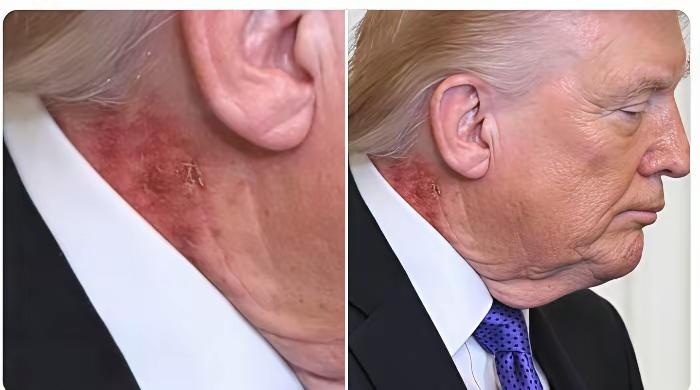 ​美国总统特朗普的健康又出现了问题，这时候看上去比平时稍微严重了一些，在其脖子处