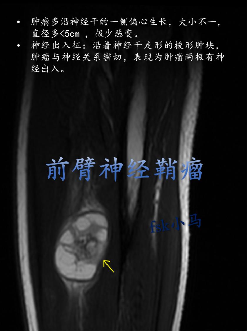 前臂神经鞘瘤