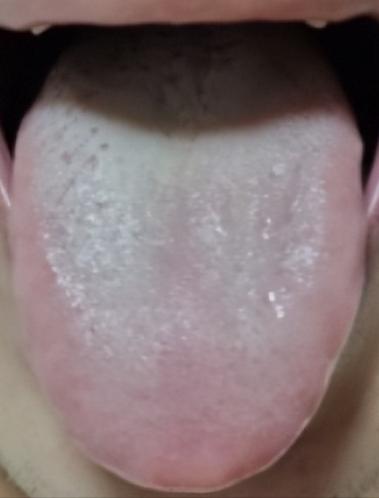 张仲景传世3大祛痰绝招！化稀痰、祛黏痰、挖老痰，从根清痰不反复

一、苓桂术甘汤