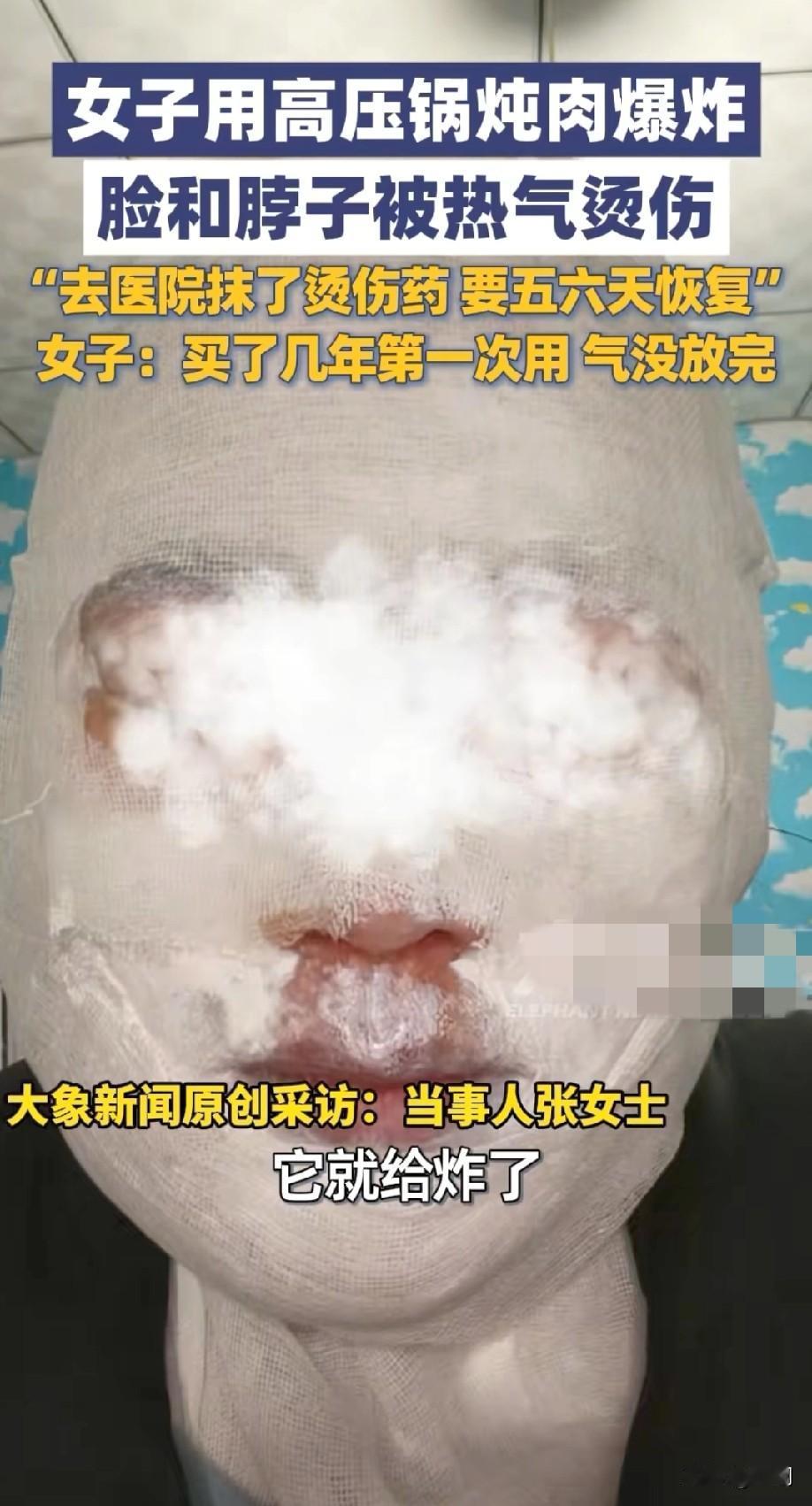 女子用高压锅炖肉被炸伤！
脸和脖子被热气又烫伤！
河北一女子使用高压锅爆炸，原因