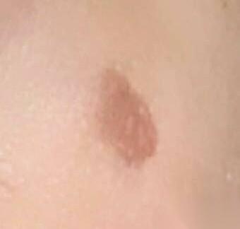 本来是去看个嘴唇干裂，结果莫名其妙就躺在了激光治疗床上。
医生指了指我眼角下面：