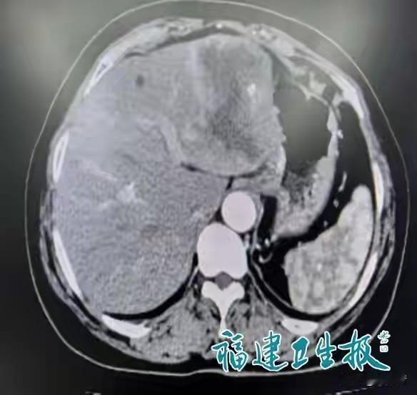 有狗的地方就容易散发这种病！这可不是吓唬人的，福建62岁的万女士就中招了，肝泡型