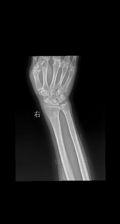 腕关节扭伤三天就诊 男 73y