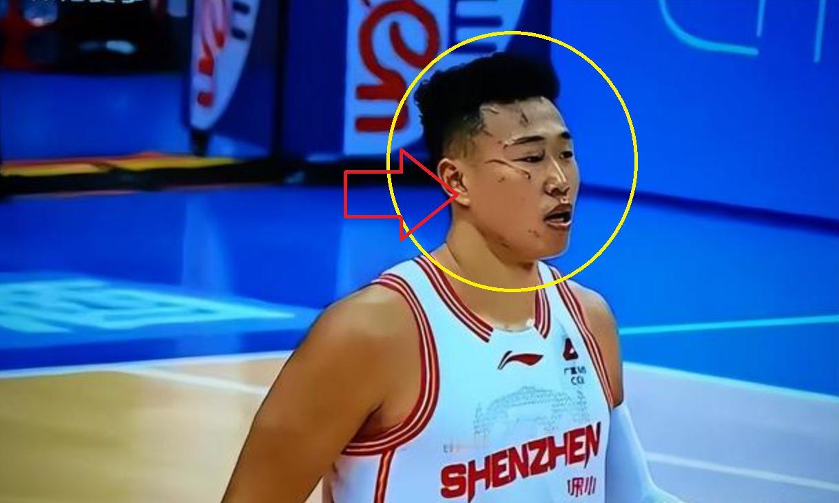 触目惊心！打了一场CBA比赛，整张脸都被“毁容”了 球迷：还有没有王法？
CBA