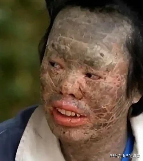 吃蛇太多变蛇人？辽宁村民韩永波爱吃蛇，吃了多年没出事，直到一条黄花松蛇下肚，皮肤