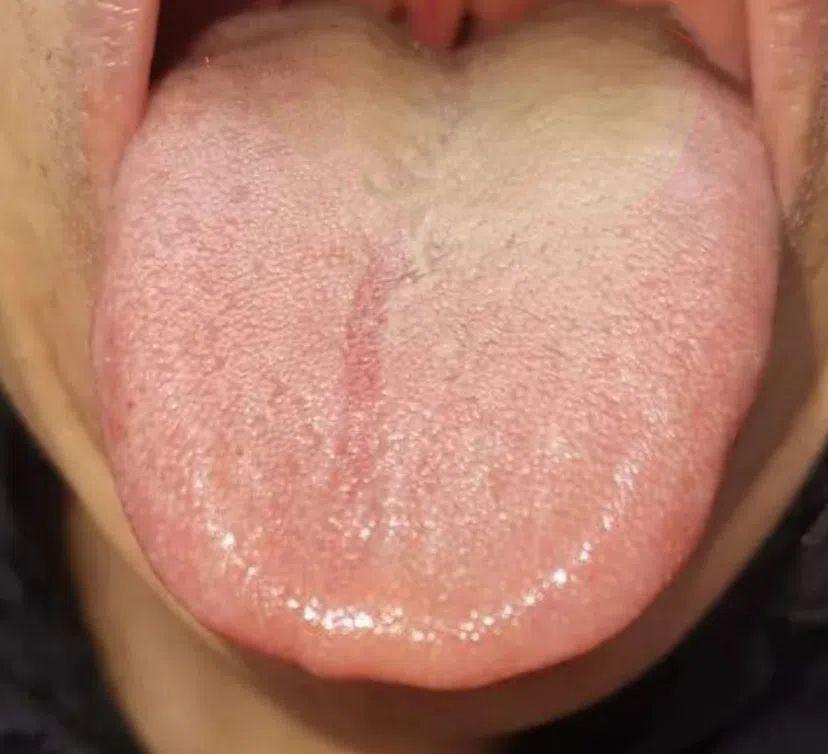 出现这种黄腻苔的男人，房事功能十有八九有问题！

患者主要问题：对房事没欲望，宗