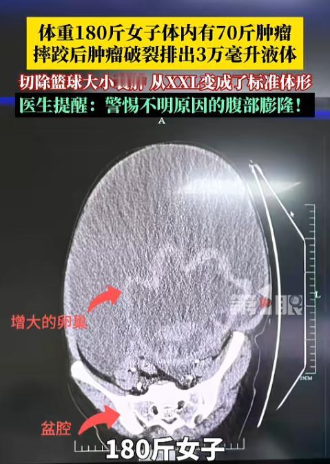 “离大谱！”浙江女子减肥多年，180斤体重纹丝不动，没想到摔了一跤后，肚子突然“