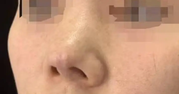 整形|女子反复鼻整形造成感染变形 医生分步修复恢复鼻子外观